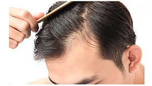 Düğün öncesi yeni trend: Saç ekimi