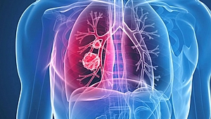 Akciğer kanserinde önemli gelişme