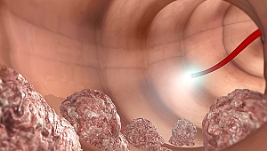 KALIN BAĞIRSAK KANSERİNDEN KORUNMANIN 7 YOLU