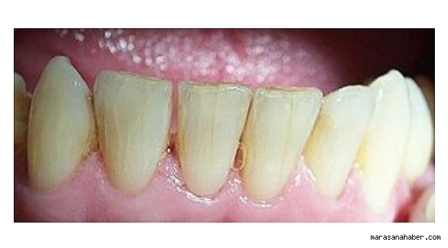 Tedavi edilmezse diş yüzeyinde çatlaklar oluşuyor!