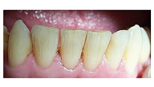 Tedavi edilmezse diş yüzeyinde çatlaklar oluşuyor!