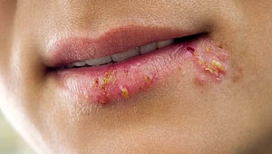 DUDAKTA UÇUK VE GÖĞÜS AĞRISI ZATÜRRE HABERCİSİ OLABİLİR