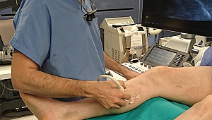 YAPIŞTIRICI İLE VARİS TEDAVİSİ