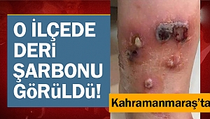 Kahramanmaraş’ta şarbon tehdidi! Deri şarbonu görüldü!