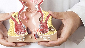 Hemoroid sorunu yaşayanlara önemli öneriler