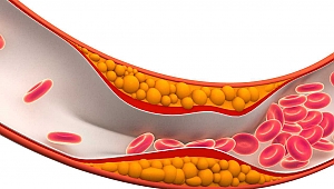 Yüksek Kolesterol Damarları Tehdit Ediyor