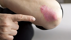 Beş sedef hastasından biri sedef romatizmasıyla da mücadele ediyor