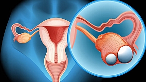 Kadınları tehdit eden 3 jinekolojik kanser!