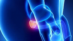 Prostat Kanseri Erkeklerde En Sık Görülen İkinci Kanser Türü