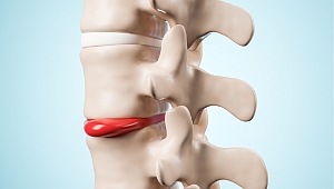 Bel ağrısı mı yoksa bel fıtığı mı?