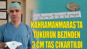 Kahramanmaraş’ta tükürük bezinden 3 cm taş çıkartıldı