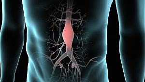 Karnınızdaki Saatli Bomba: Aort Anevrizması