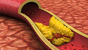 Türkiye’de Her Yıl Yaklaşık 30 Bin Kişi Tromboz Nedeniyle Hayatını Kaybediyor