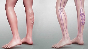 Varisi Tetikleyen 5 Önemli Faktör