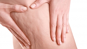 Dermapen Mucizesi İle Selülit Tedavisinde Devrim