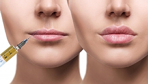 Dudak Dolgusu ile Daha Dolgun Dudaklar