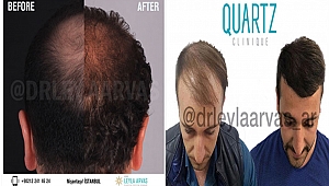 Saç Ekiminde Kullanılan En İyi Yöntem: Fue Tekniği İle Doğal Görünüm