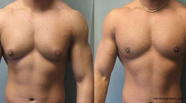 Jinekomasti nedir nasıl oluşur