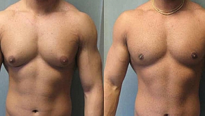 Jinekomasti nedir nasıl oluşur