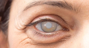 Katarakt Ameliyatı Hakkında Bilinmesi Gerekenler