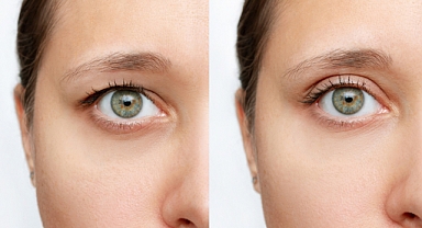 Göz kapağı düşüklüğü ciddi hastalıkların belirtisi olabilir!