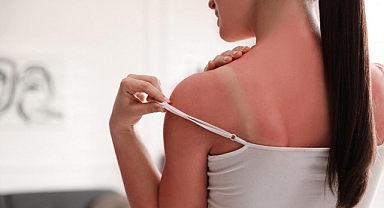 Güneş yanığına karşı 10 kritik kural!