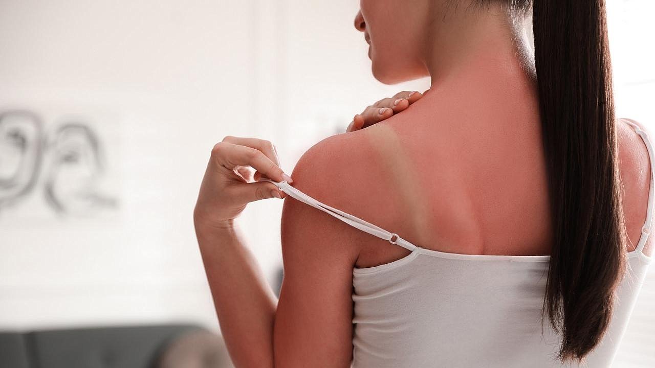 Güneş yanığına karşı 10 kritik kural!