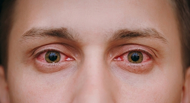 Kırmızı Göz Salgını Kalıcı Hasar Bırakıyor