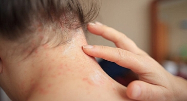 Kahramanmaraş depremi vitiligo hastalığını artırdı