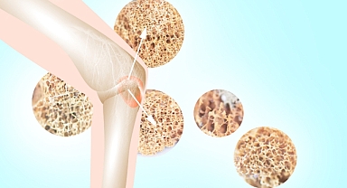 Kemik Metastazı Hakkında Bilmeniz Gereken 3 Önemli Bilgi