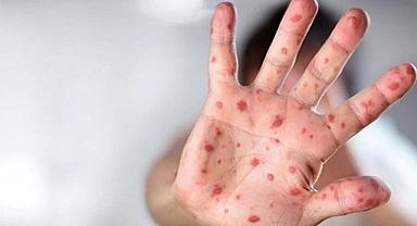 Maymun Çiçeği Virüsü Avrupa’ya Ulaştı: İsveç İlk Vakayı Doğruladı