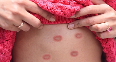 Maymun Çiçeği Virüsü Pandemi Tehdidi Oluşturabilir Mi?