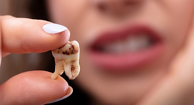 Tedavi edilmeyen diş çürükleri genel sağlığı tehdit ediyor!