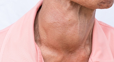 Hipertiroidi Tedavi Edilmezse Ciddi Sağlık Sorunlarına Yol Açabilir