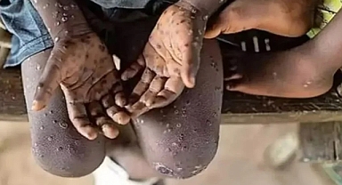 Maymun Çiçeği Afrika’da endişelendiriyor