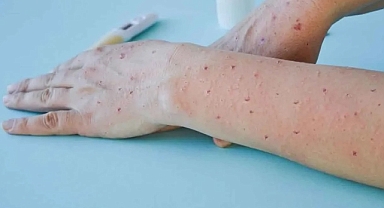 Dünyayı korkutan salgın büyüyor! Bir haftada vakalar yüzde 63 arttı