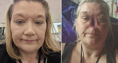 Nezle Sandı, Kanser Çıktı! İki Yıldır Burnu Olmadan Yaşıyor