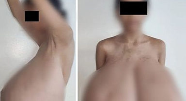 15 Yaşındaki Kızın Göğüsleri 16,5 Kiloya Ulaştı! Nadir Hastalık Hayatını Kabusa Çevirdi
