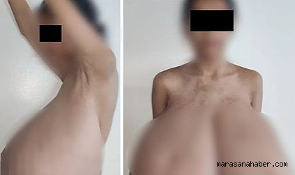 15 Yaşındaki Kızın Göğüsleri 16,5 Kiloya Ulaştı! Nadir Hastalık Hayatını Kabusa Çevirdi